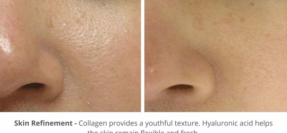 HydraFacial before and after photo technology