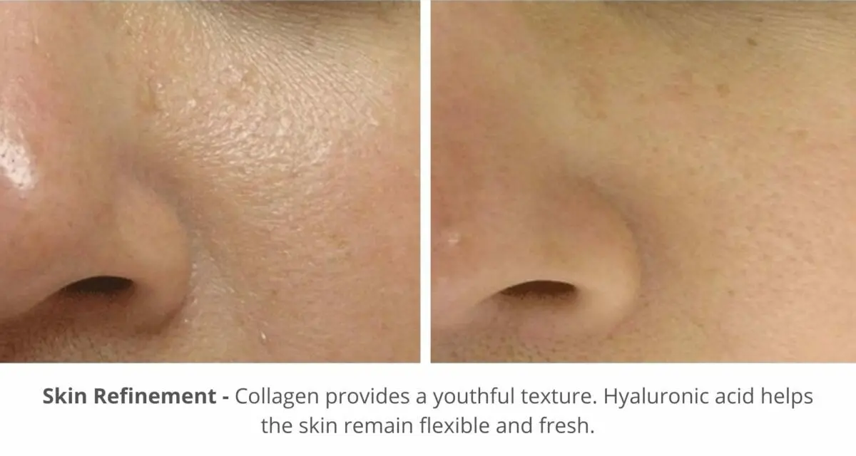 HydraFacial before and after photo technology