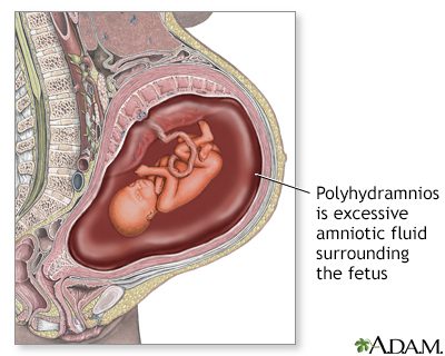 Hydramnios, oligoamnios: too much or not enough amniotic fluid?