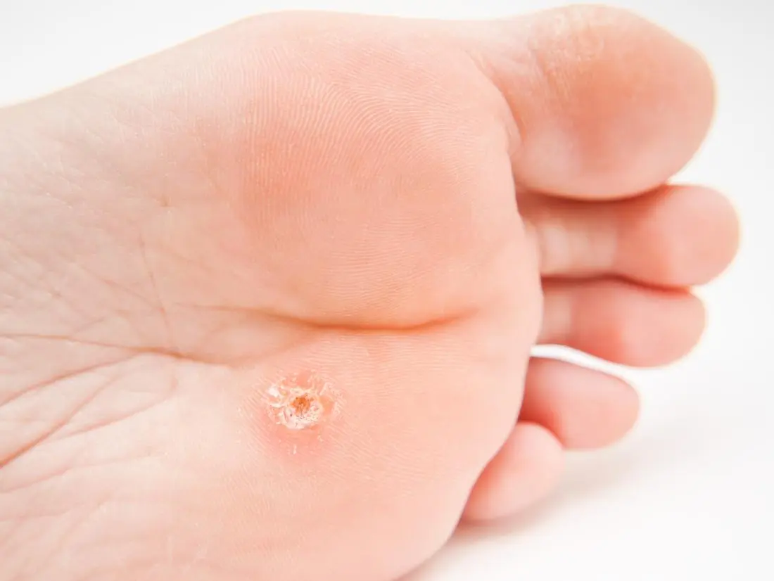 Hyperkeratosis in the foot: what are the causes?