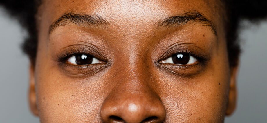 Hyperpigmentation: who is affected?