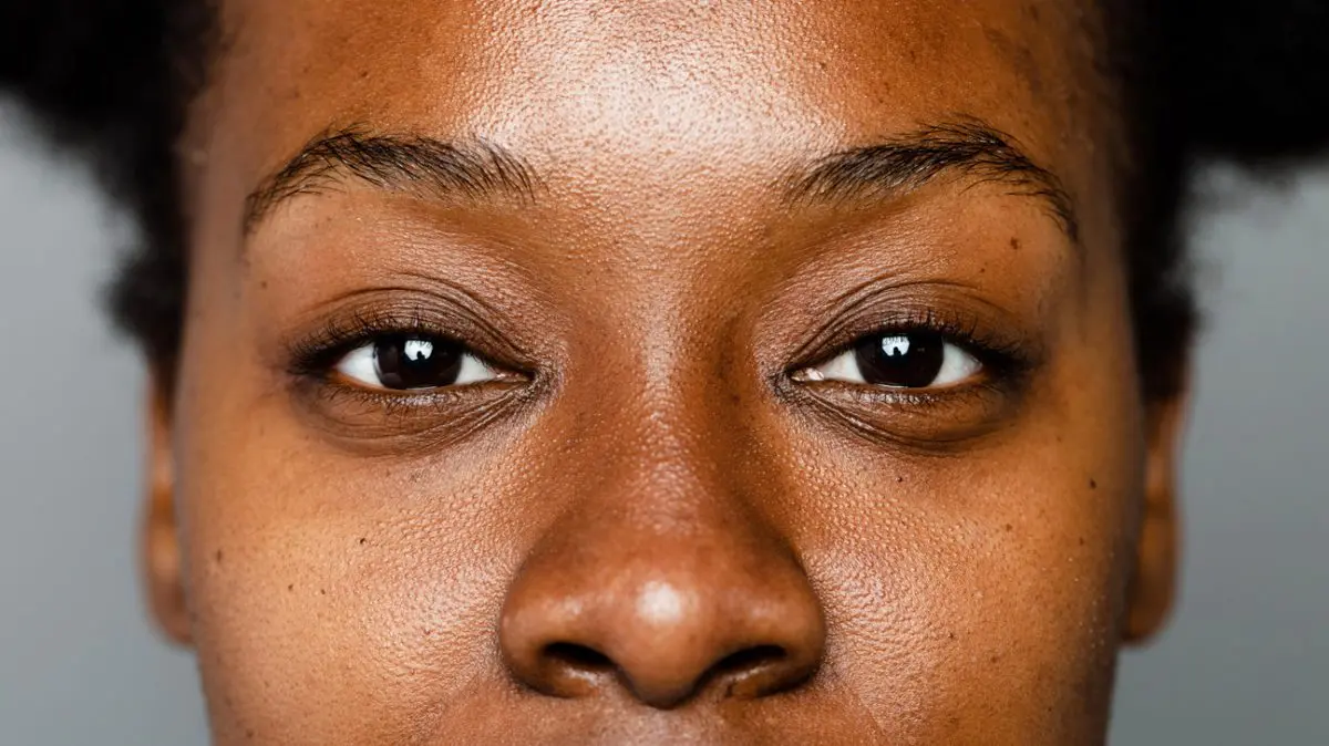 Hyperpigmentation: who is affected?