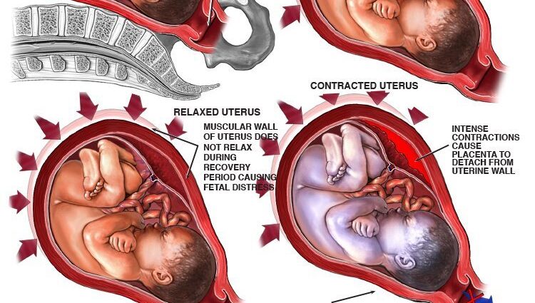 Hypertonie während der Schwangerschaft