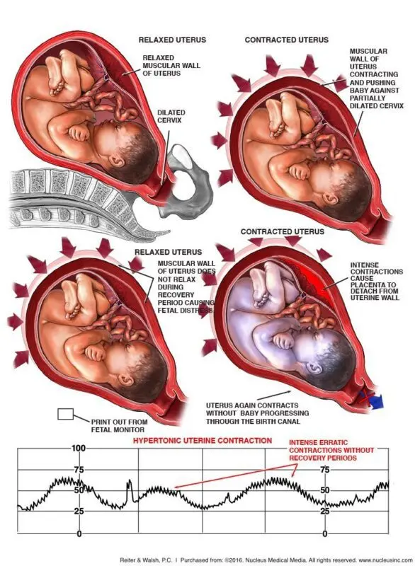 Hypertonia during pregnancy