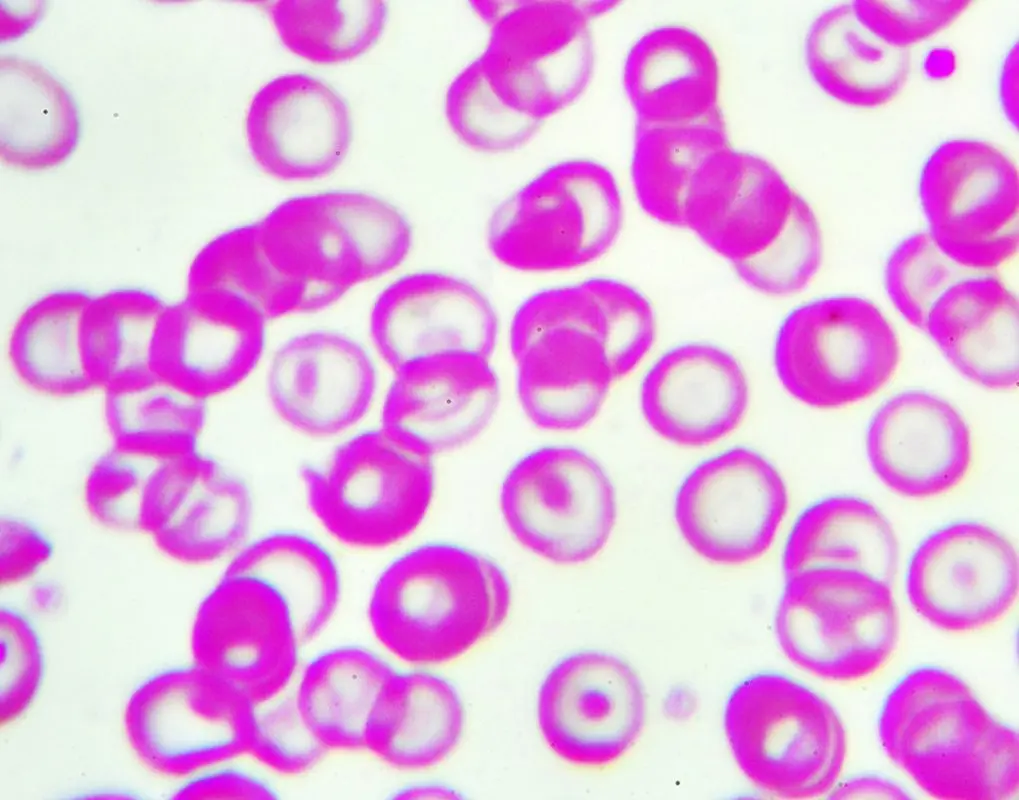 Hypochromia: definition, symptoms, treatments