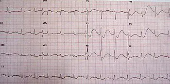 Hypokalaemia