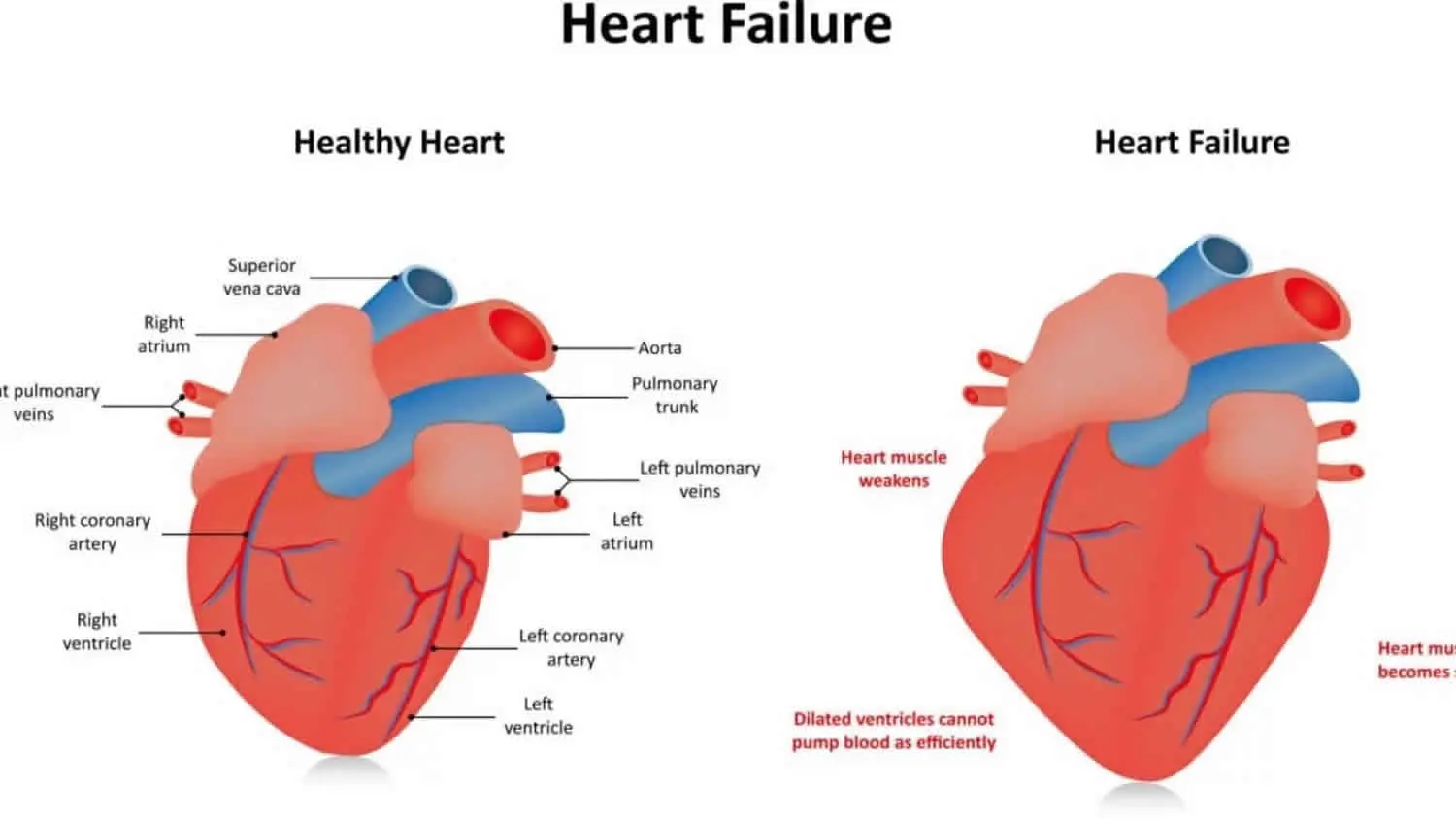 Hypokinesia: definition, causes and treatments