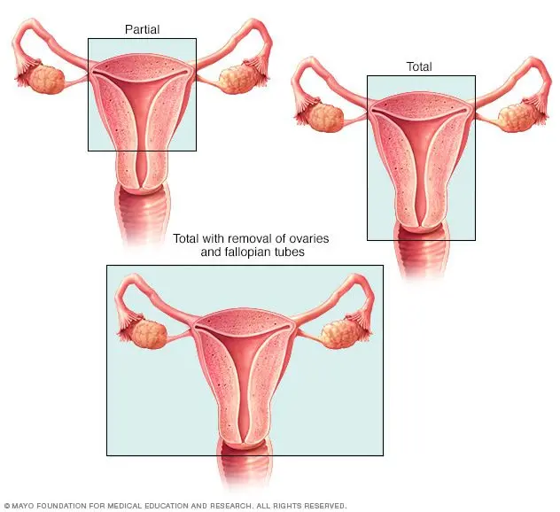 Hysterectomy