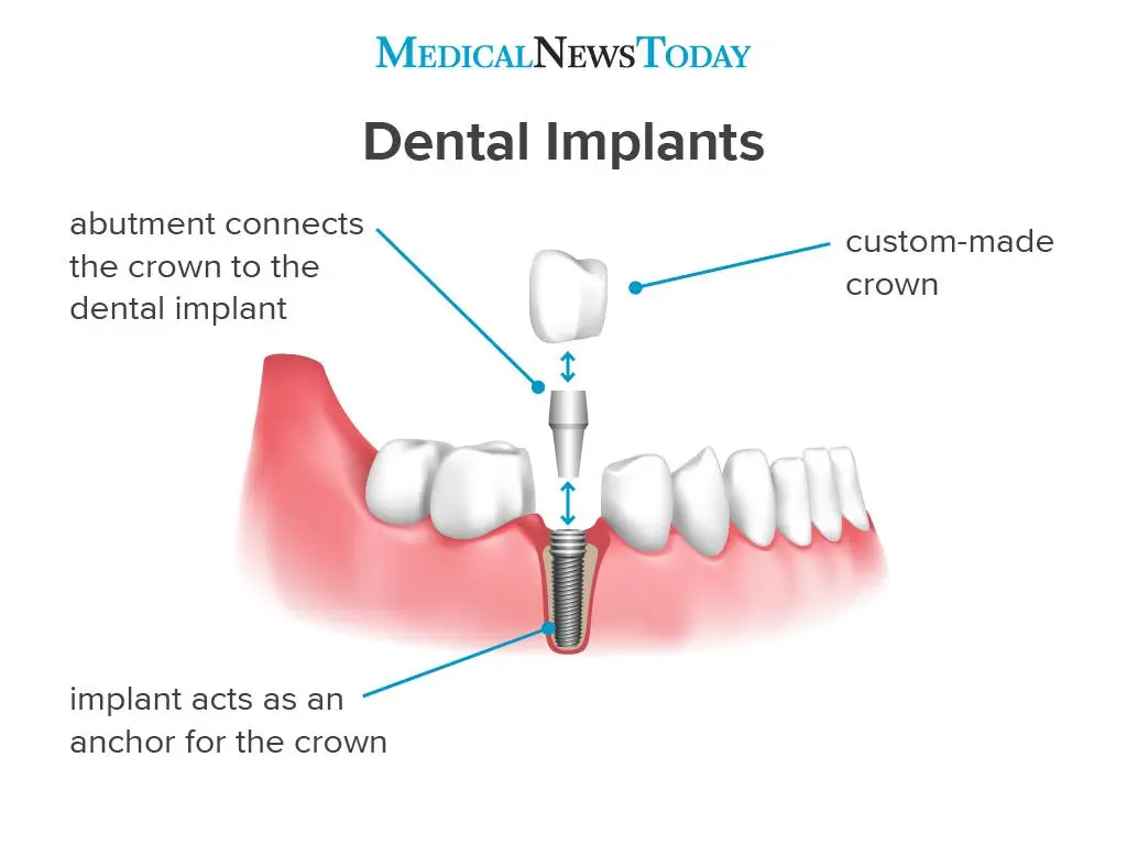 Implantology: how are dental implants placed?