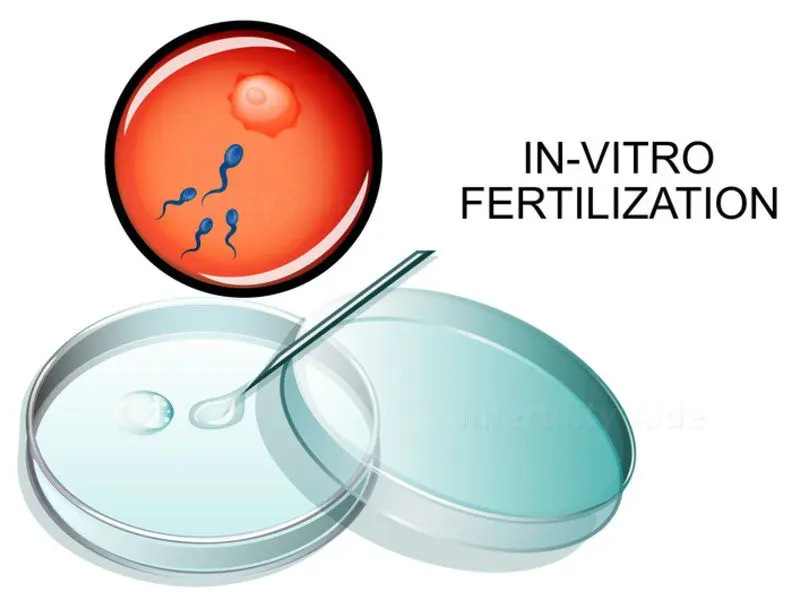 In Vitro Fertilization (IVF)