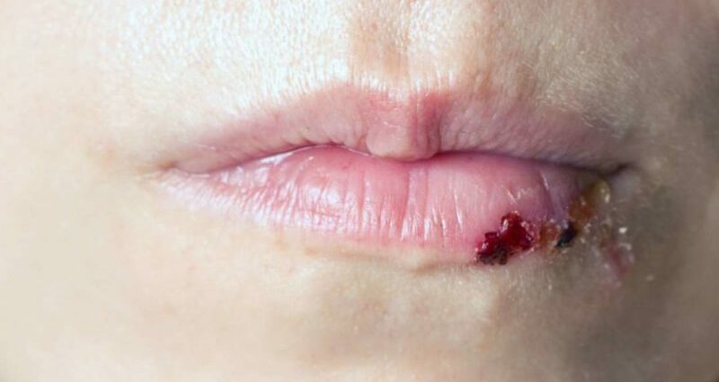 부러진 입술은 어떤 경우에 봉합하는지, 얼마나 치유되는지, 번지는 방법