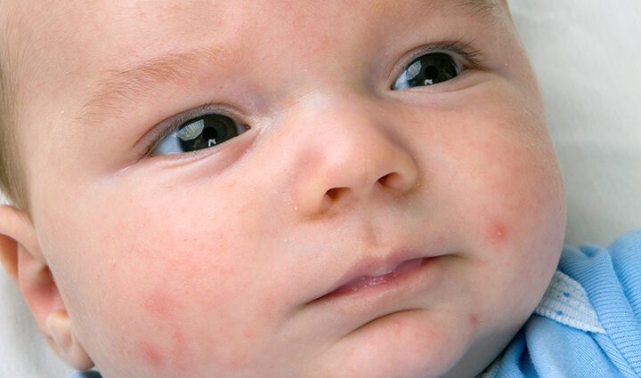 Infant acne: what to do when baby has breakouts?