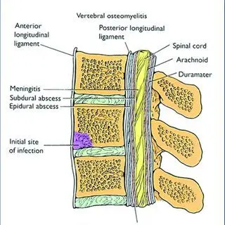 Infectious spondylodiscitis: definition and treatment