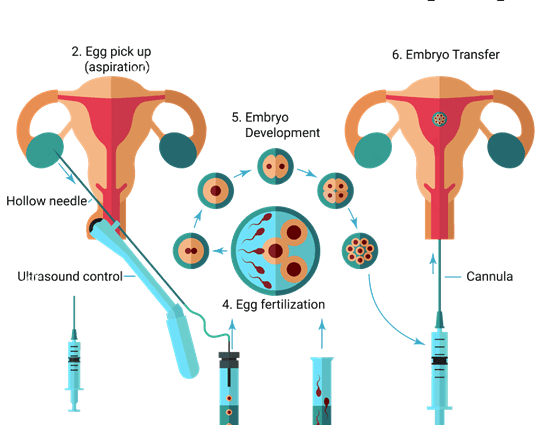 Infertility treatment and how the IVF procedure works