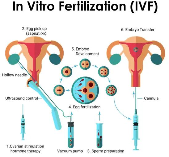 Infertility treatment and how the IVF procedure works