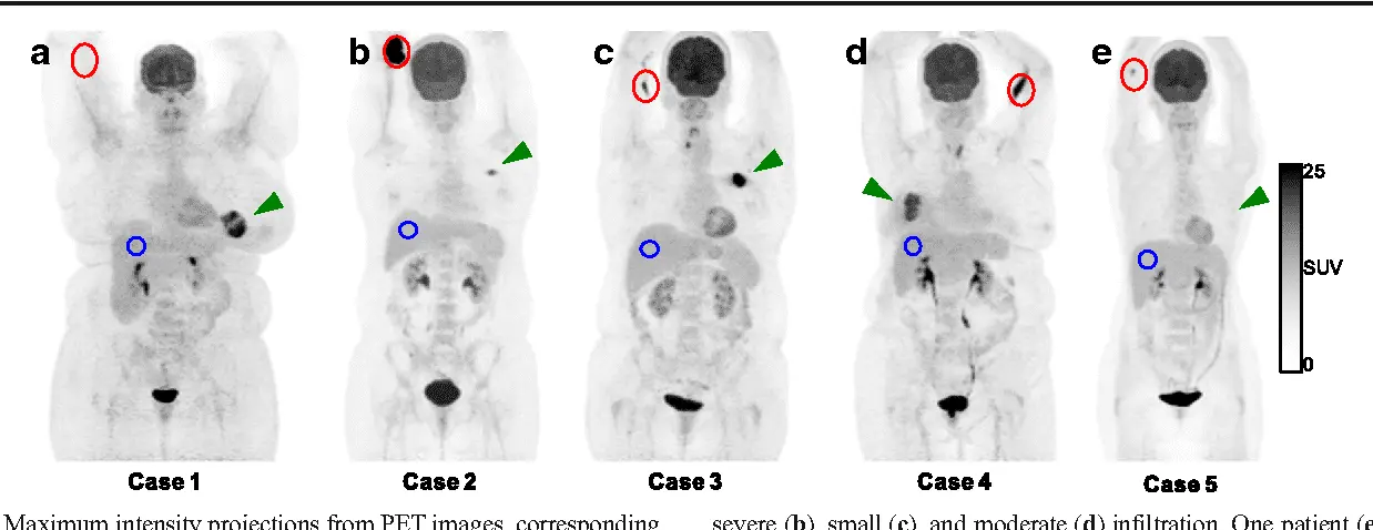 Infiltration of the dose