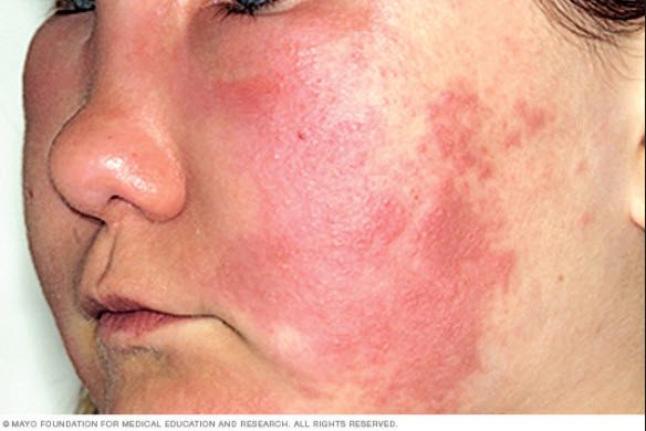 Inflammations on the skin of the face: how to treat