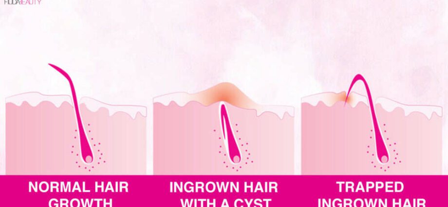 Ingrown hair: how to get rid of after epilation? Video