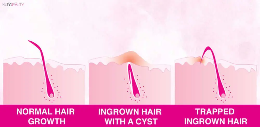 Ingrown hair: how to get rid of after epilation? Video