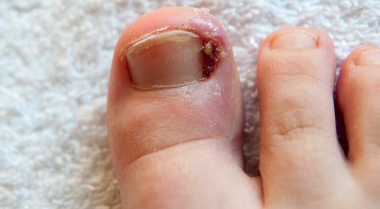 Ingrown toenail: how to get rid of? Video