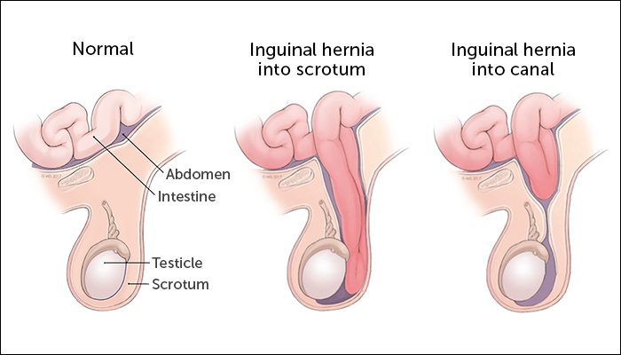 Inguinal hernia &#8211; Our doctor&#8217;s opinion and references