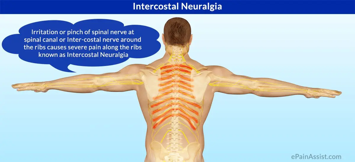 Intercostal neuralgia, Symptoms of intercostal neuralgia, Intercostal neuralgia: causes, Intercostal neuralgia: methods of treatment, Alternative treatment of intercostal neuralgia.