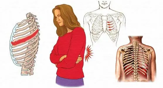 Intercostal neuralgia