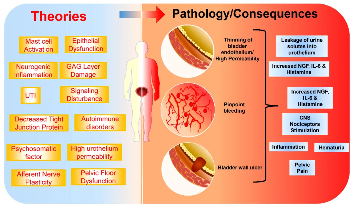 Interstitial cystitis &#8211; Sites of interest