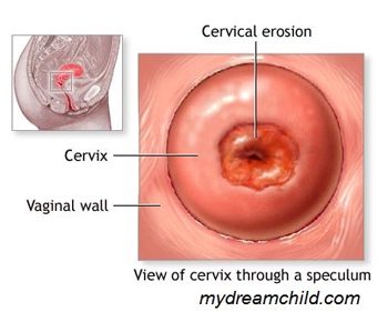 Is it possible to cauterize erosion during pregnancy