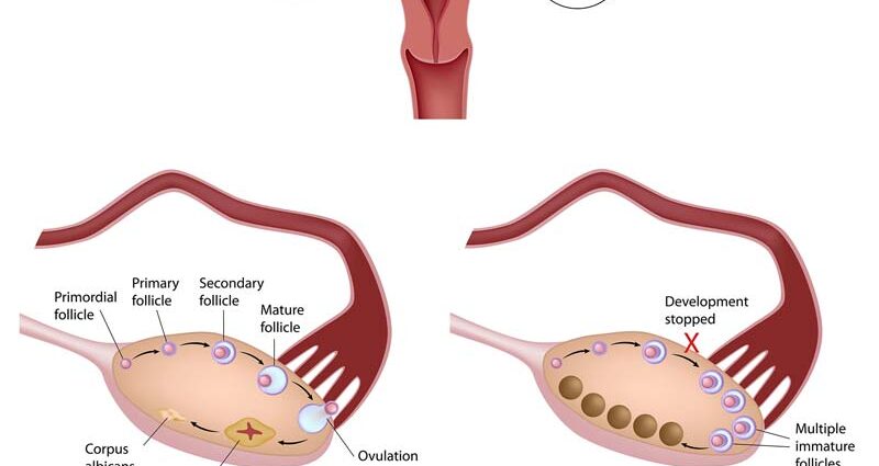 Is pregnancy possible with polycystic ovary