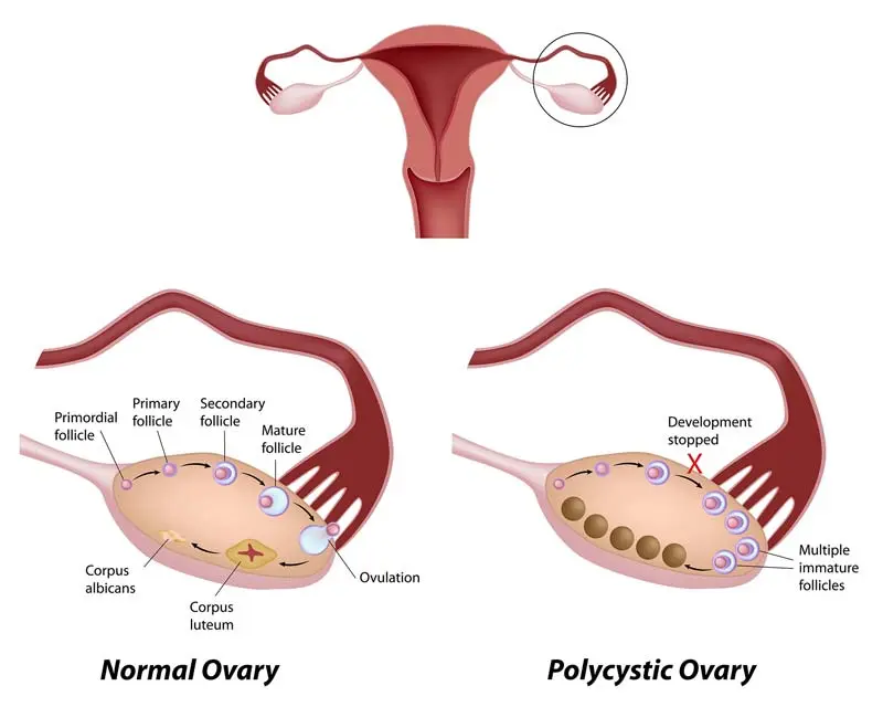 Is pregnancy possible with polycystic ovary