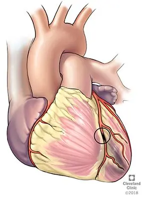 Ischemia: how to treat a blocked artery?