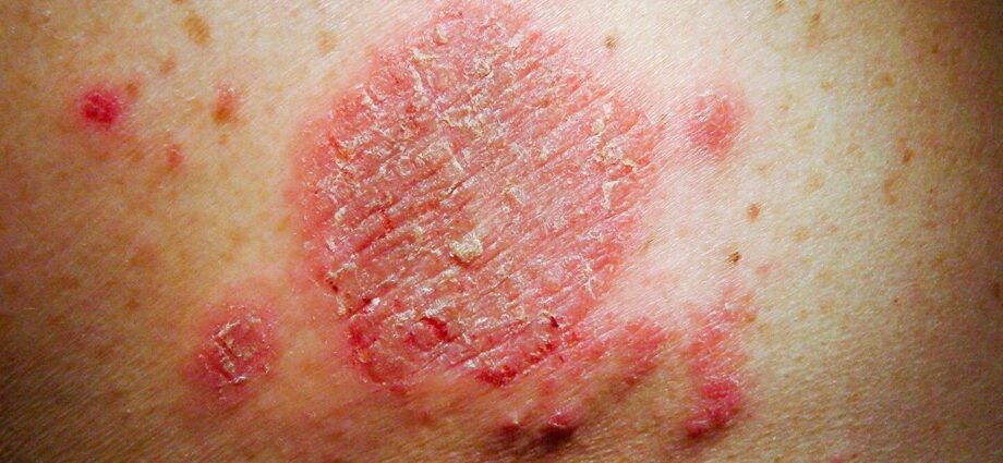 Itching and redness of the skin: how to treat?