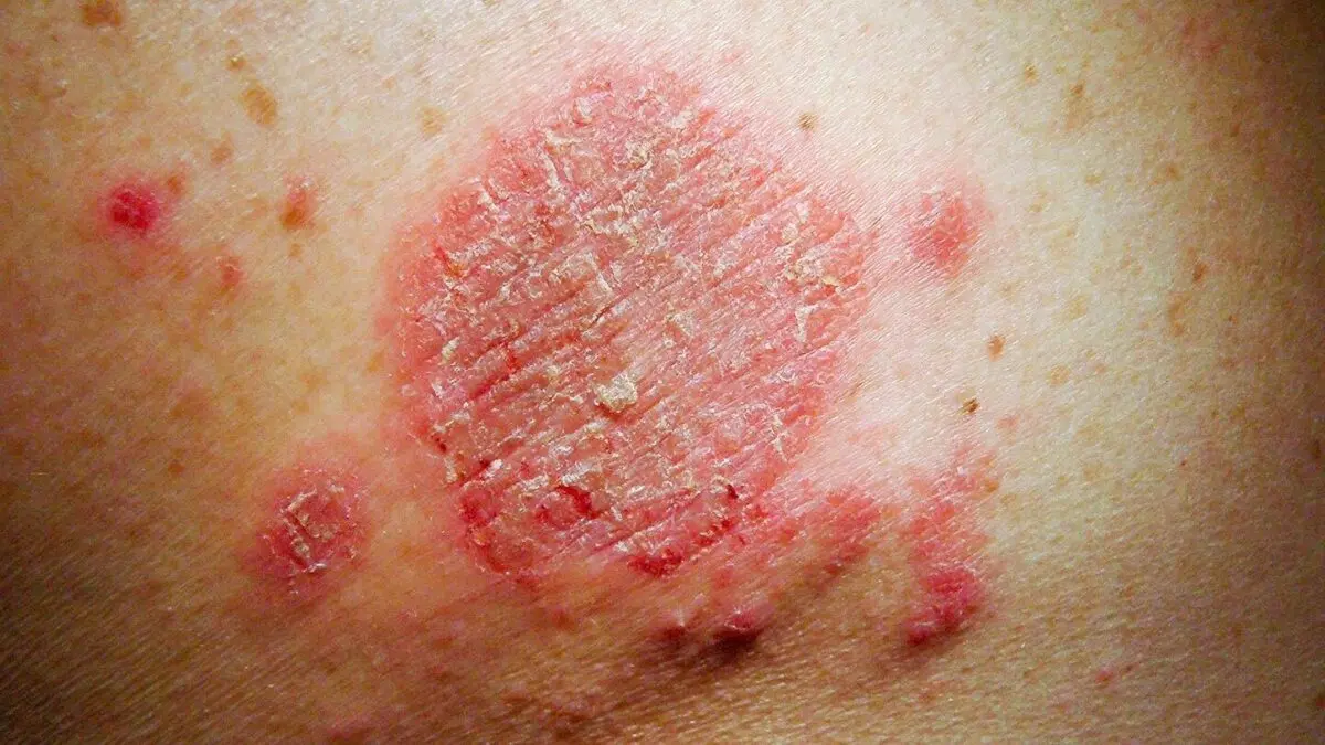 Itching and redness of the skin: how to treat?