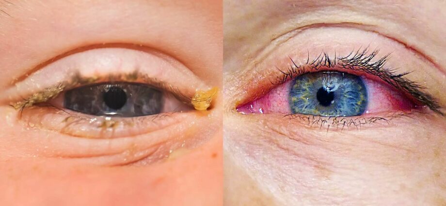 Viszkető szem, orrviszketés ... Mi lenne, ha szezonális allergia lenne?