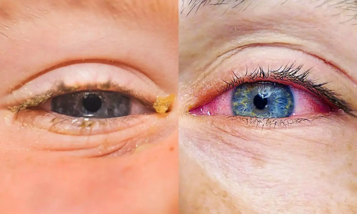 Itchy eyes, itchy nose… What if it was a seasonal allergy?