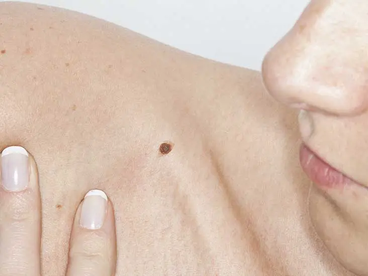 Itchy mole: how to soothe a scratched mole?