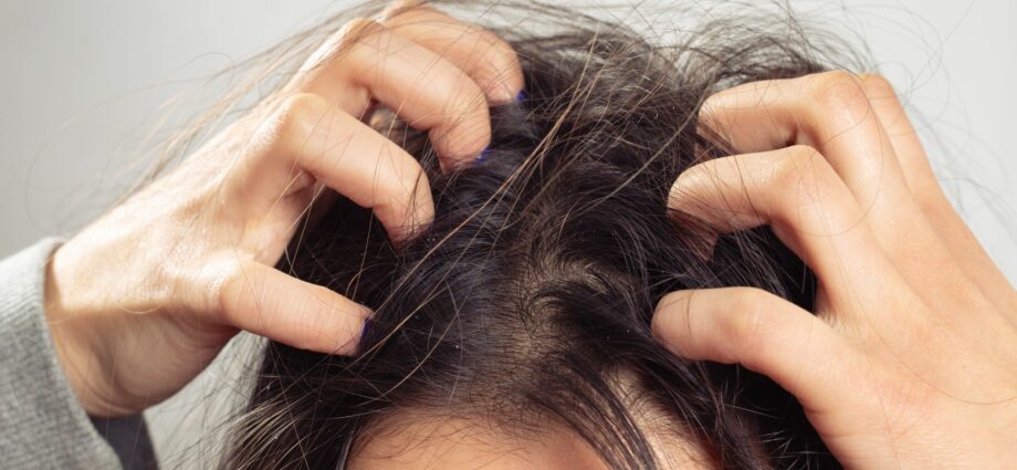 Itchy scalp, dandruff and hair loss, causes