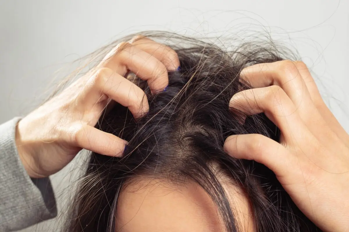 Itchy scalp, dandruff and hair loss, causes