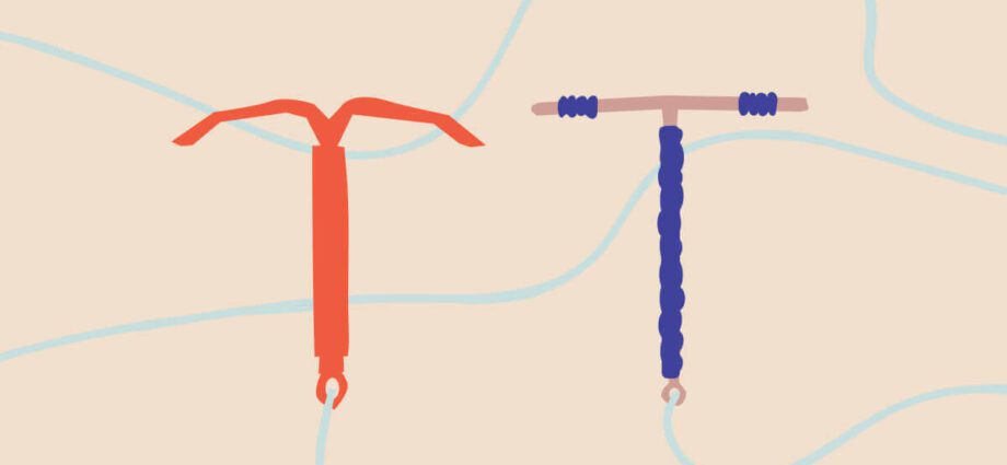 IUD: all about the IUD before pregnancy