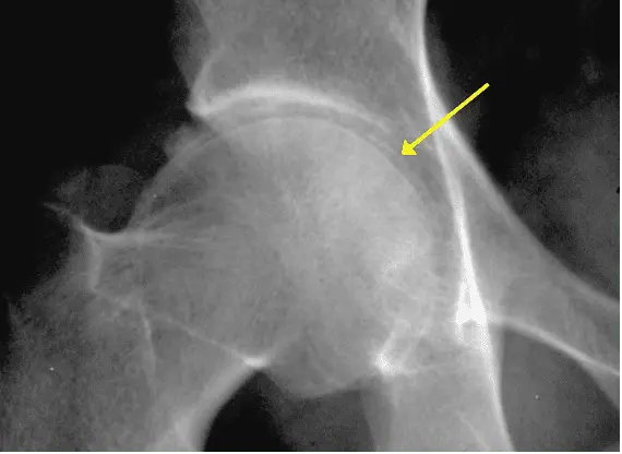 Joint chondrocalcinosis ± hydroxyapatitis rheumatism