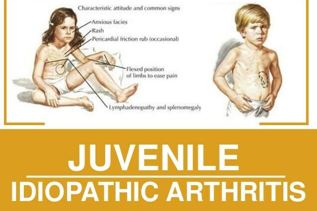 Juvenile arthritis