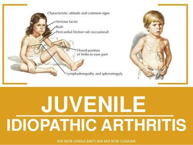 Juvenile arthritis