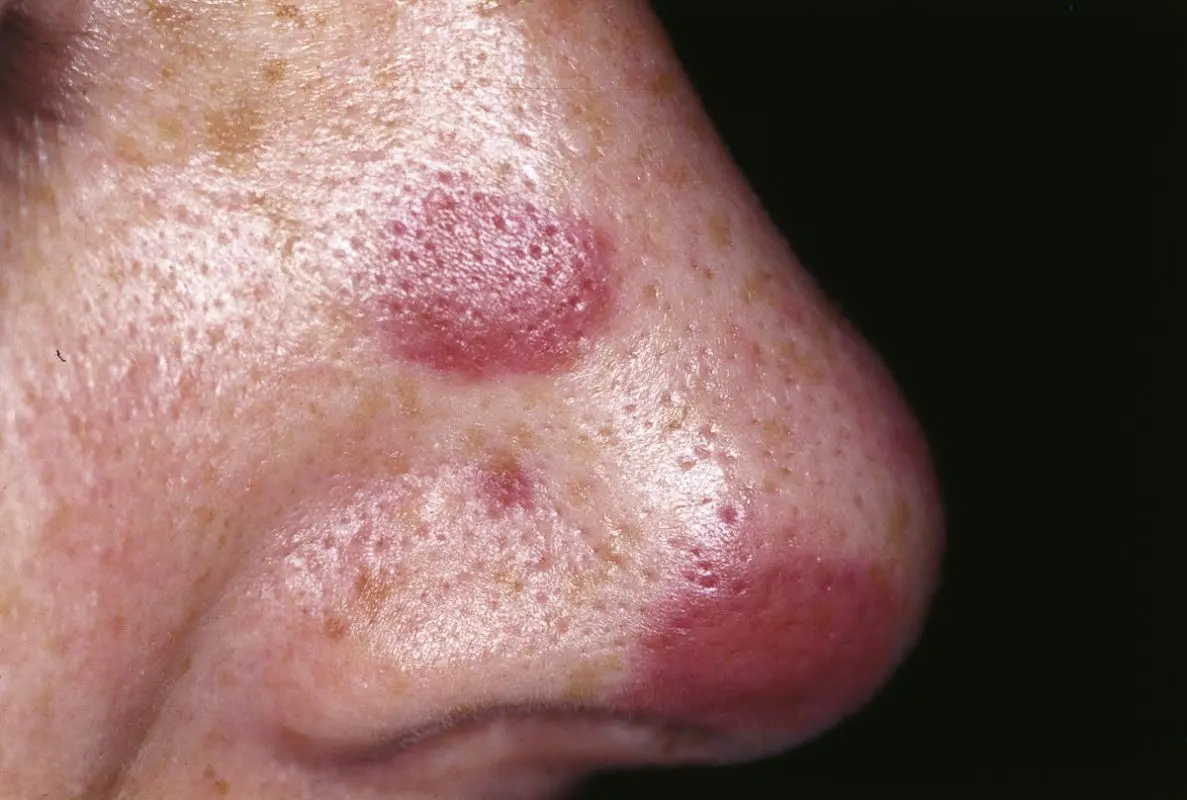 Kaposi&#8217;s sarcoma