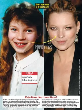 Kate Moss photo: plastic surgery stars photo