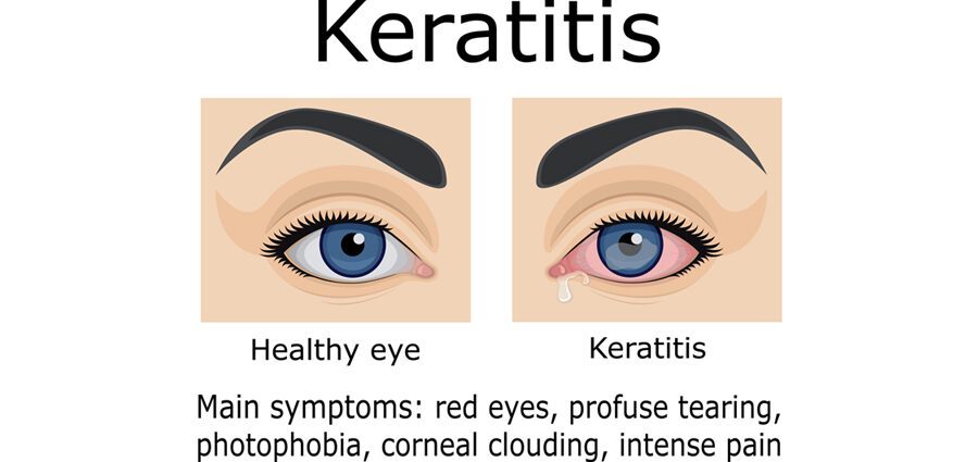 Keratitis: antony, soritr'aretina, fitsaboana