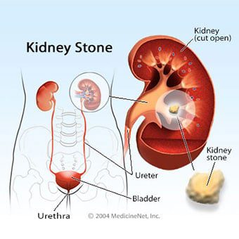 Kidney stones (koda duwatsu)