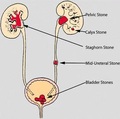 Kidney stones (renal lithiasis) &#8211; Sites of interest