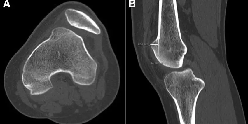 Knee CT scan: for what reasons and how is the examination carried out?