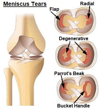 Blocco del ginocchio